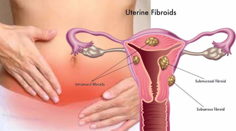 Uterine Fibroids Treatment by Dr. Shilpa Dhameja, Gynecologist Vasant Kunj