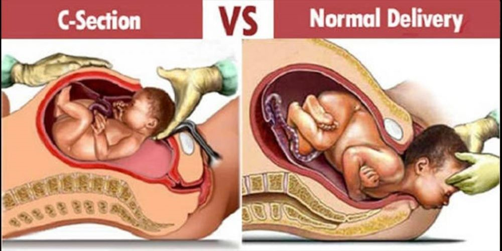Normal Delivery by Dr. Shilpa Dhameja, Obstetrician Vasant Kunj